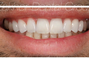 Zakhor Dental Group-Los Angeles Cosmetic Dentist- porcelain Veneers, Invisalign, 24 hour Emergency Dental Services- image
