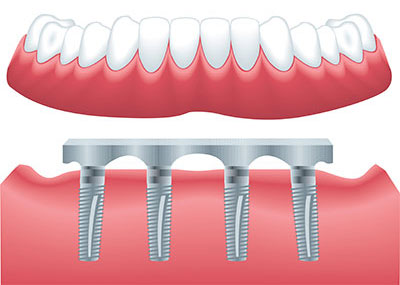 1899 Dental Implant