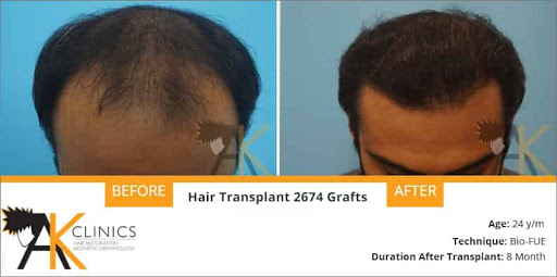 AK Clinics Hair Transplant Delhi - Best Hair Transplant Clinic