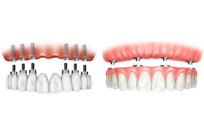 Implante Dental Santiago Centro