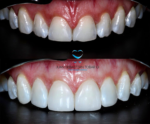 Dr. Juan Tobar Odontología - Diseño de Sonrisa y Relleno de labios con Acido Hialuronico