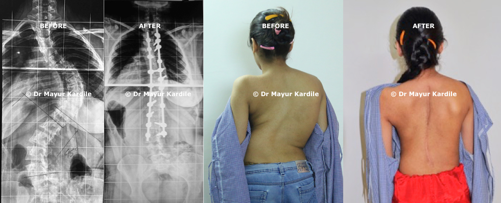 Dr. Mayur Kardile, Best Spine Surgeon and Specialist in Pune at Jehangir Hospital