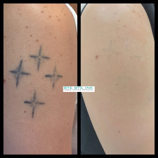 Explore hunger games tattoo ideas, creative tattoo ideas in Middle Village, available at Bye Bye Ink Laser Tattoo Removal