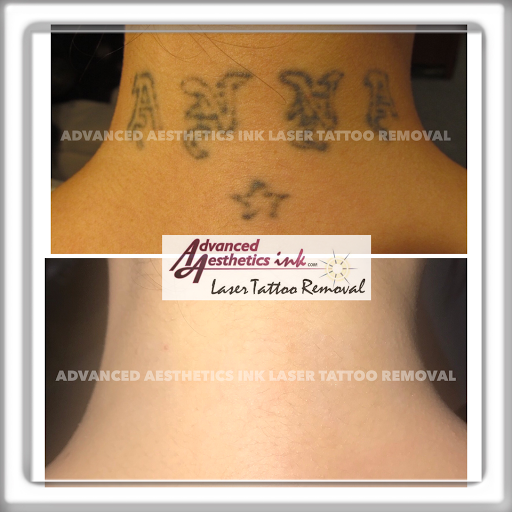 Explore bestfriend tattoos ideas, creative tattoo ideas in South Dartmouth, available at Advanced Aesthetics Ink Laser Tattoo Removal