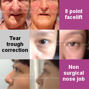 رفع الجلد البلازما - Plasma Skin Lift
