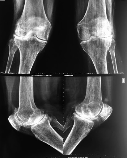 Asistencia Medica Traumatológica, Cirugía de Cadera y Rodilla, Santa Cruz Bolivia