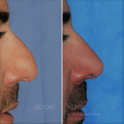 London Rhinoplasty