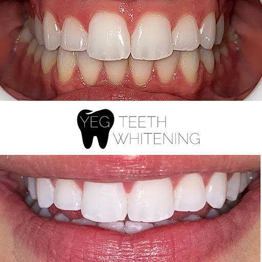 YEG Teeth Whitening