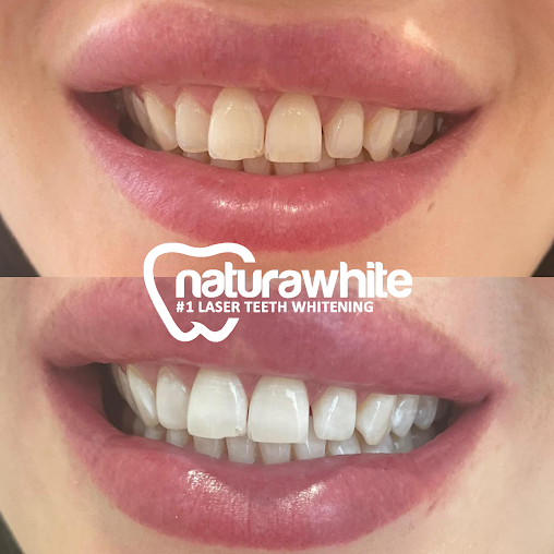 Teeth Whitening Company - Melbourn - Teeth Whitening Company - Melbourn