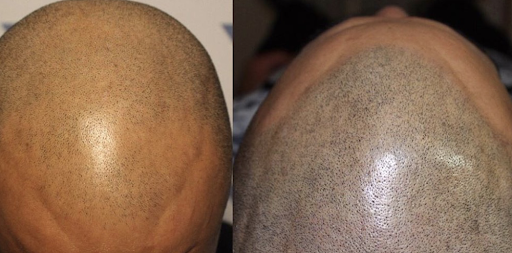 Explore bart and lisa tattoo ideas, creative tattoo ideas in Minneapolis, available at Medical Tattoo & Cosmetic Centers of America