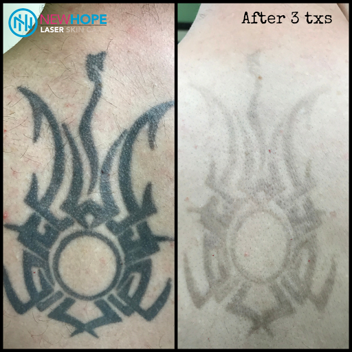 Explore divorce tattoo ideas for guys, creative tattoo ideas in Westminster, available at Newhope Laser Skin Care