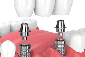 Dentista Chihuahua BS Consultorio Dental Implantologia Implantes dentales image