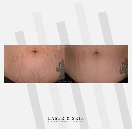 Explore cover up tattoo ideas, creative tattoo ideas in Southampton, available at Laser & Skin Surgery Center of New York - Southampton