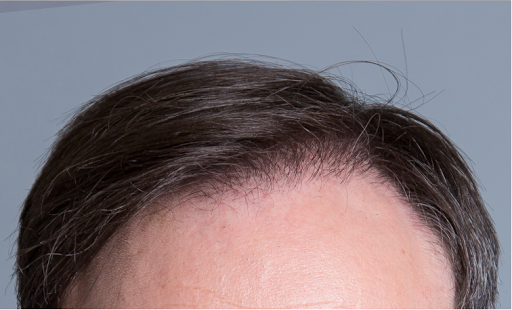 Hair Transplantation Clinic «Bosley Medical - Atlanta», reviews and photos, 3379 Peachtree Rd NE #800, Atlanta, GA 30326, USA