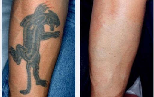 Explore enlightenment tattoo ideas, creative tattoo ideas in Middle Village, available at Bye Bye Ink Laser Tattoo Removal