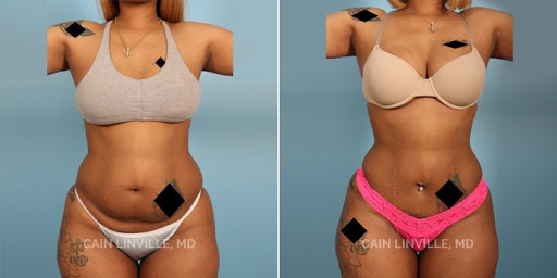 Linville Plastic Surgery Houston | Breast Augmentation