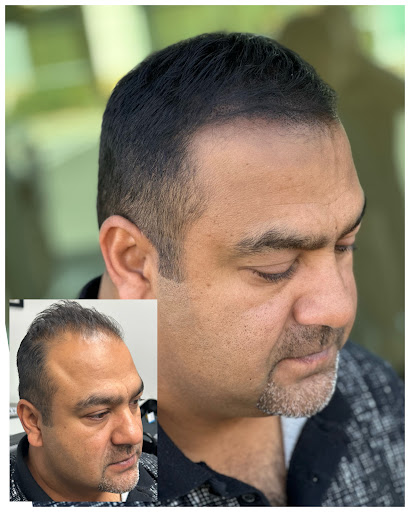 Precise Scalp Micro - Scalp Micropigmentation Service and Training image