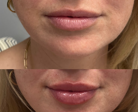 Lip augmentation injection in Los Angeles thumbnail