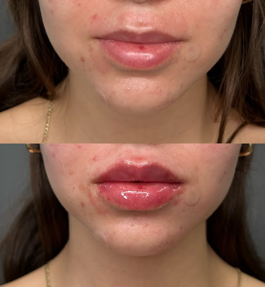 Lip augmentation injections in West Los Angeles thumbnail