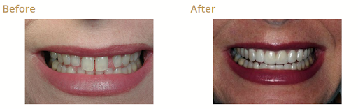 Teeth whitening service Irvine