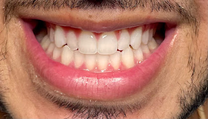 Glorious Smile Natural Teeth Whitening