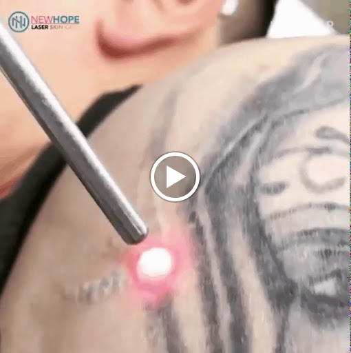 Explore air tattoo ideas, creative tattoo ideas in Briarcliff Manor, available at Laser Luxury