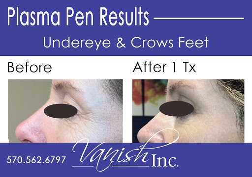 Explore dog tattoo ideas for females, creative tattoo ideas in Williamsport, available at Vanish Laser & Skin, Inc.