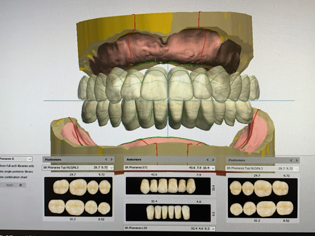 Digital dentures Glasgow, scan and fit - Dentist