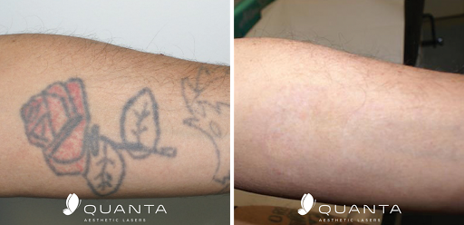 Explore skull tattoo ideas for men, creative tattoo ideas in Glen Burnie, available at MD Laser Tattoo Removal Baltimore