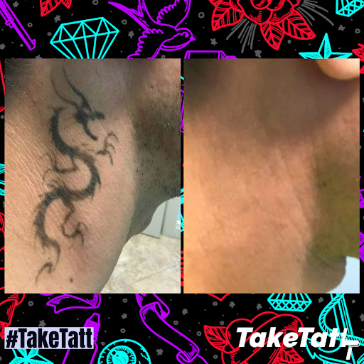 Explore ocd tattoo ideas, creative tattoo ideas in Canton, available at TakeTatt Tattoo Removal
