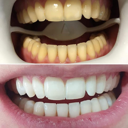 Belous Dental Group - Clinica Stomatologica | Implant dentar | Albire dinti | Urgente stomatologice Unirii | Sector 3