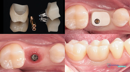Dentálna implantológia