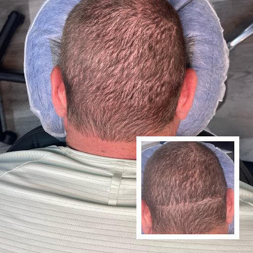 Explore wedding ring tattoo ideas for him, creative tattoo ideas in Roseville, available at NuHair Ink. Scalp MicroPigmentation & Aesthetic Clinic of Sacramento