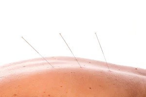 Vital Point Acupuncture image