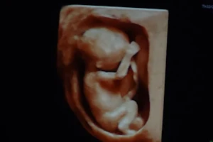 Hopes and Dreams 4D/HD Ultrasound image