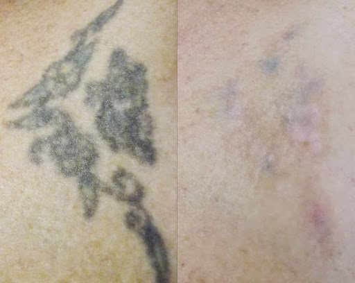 Find charm bracelet tattoo ideas for your next unique tattoo in Weatherford at Vanish Laser Tattoo Removal and Skin Aesthetics