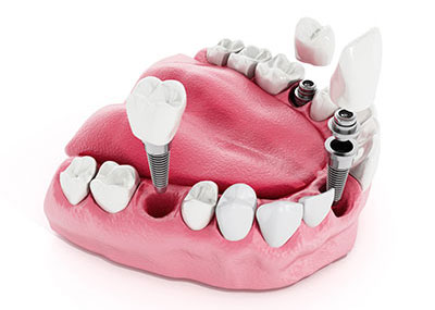 1899 Dental Implant