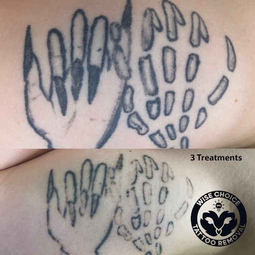 Explore anarchy tattoo ideas, creative tattoo ideas in Denver, available at Wise Choice Tattoo Removal
