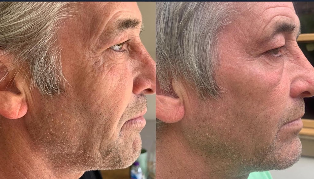 Wrinkle Treatment WA 98005