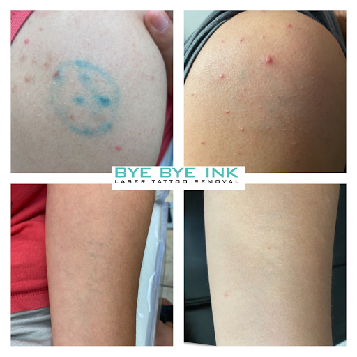 Explore korn tattoo ideas, creative tattoo ideas in Middle Village, available at Bye Bye Ink Laser Tattoo Removal