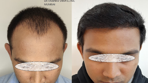 Dr Vaibhav Shah Hair Transplant clinic Mumbai