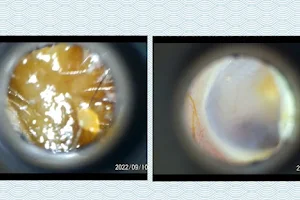 Ear wax removal clinic: Crystal Clear Hearing image