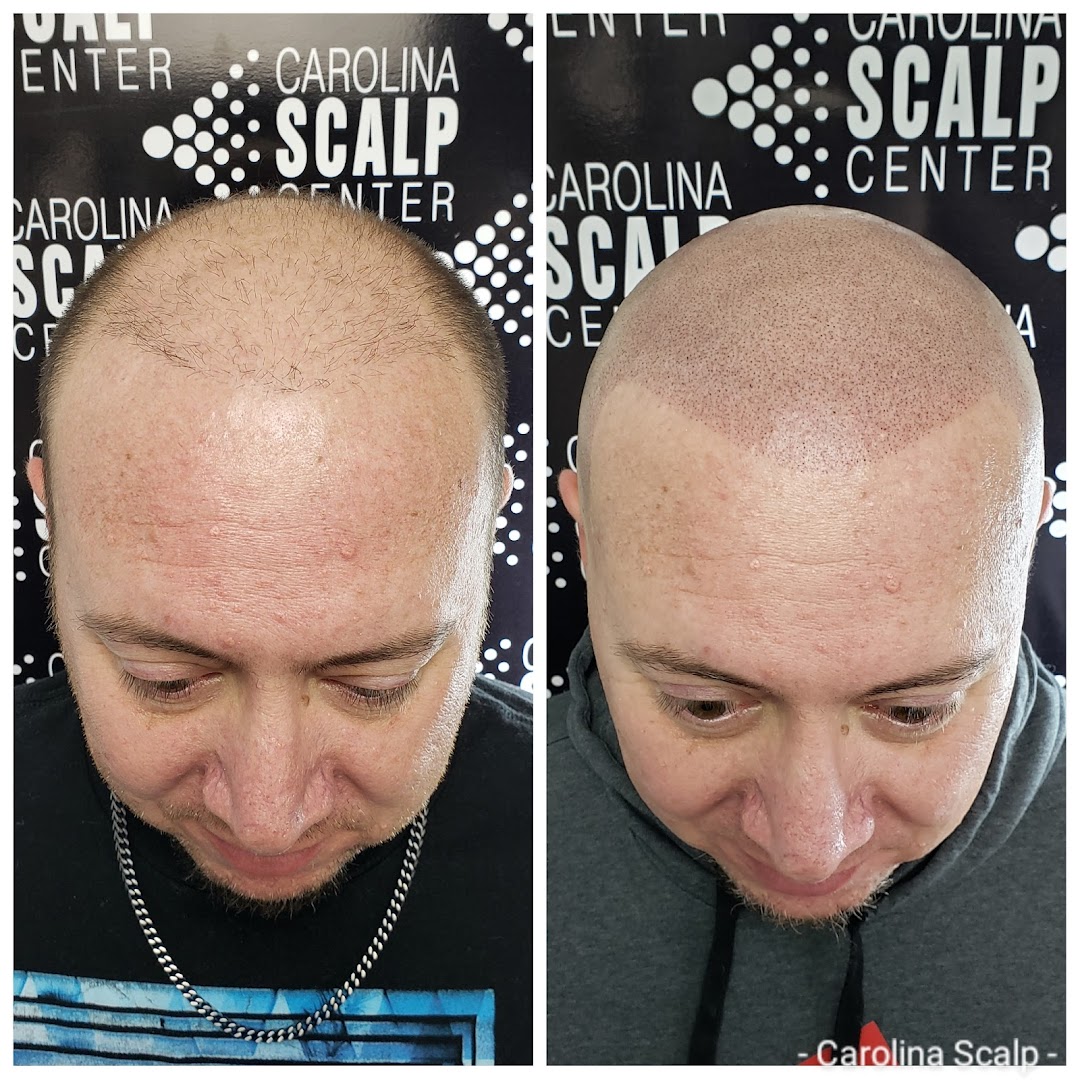 Carolina Scalp CenterScalp Micropigmentation