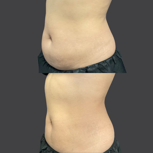 Explore cancer survivor tattoo ideas for guys, creative tattoo ideas in Whittier, available at Skin Perfect Medical Aesthetics