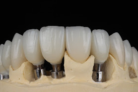 Leonardo Bueno Odontologia Especializada - Dentista setor Bueno Goiânia - Implantes dentários