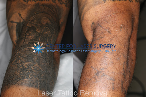 Explore semi colon tattoo ideas, creative tattoo ideas in Washington, available at Center For Laser Surgery