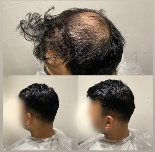 عيادات تساقط الشعر - كارلايل - The Hair Loss Clinics - Carlisle