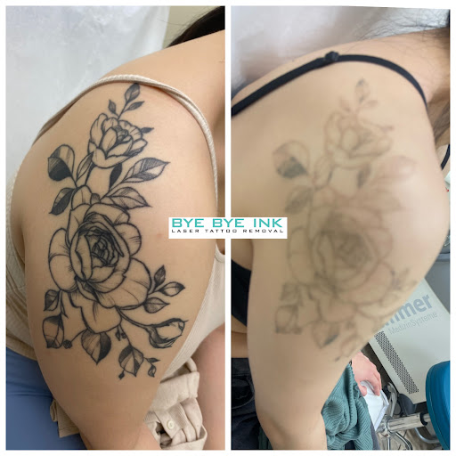 Explore easy tattoo cover up ideas, creative tattoo ideas in Middle Village, available at Bye Bye Ink Laser Tattoo Removal