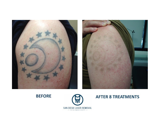 Explore tattoo ideas loyalty, creative tattoo ideas in San Diego, available at Removery Tattoo Removal & Fading