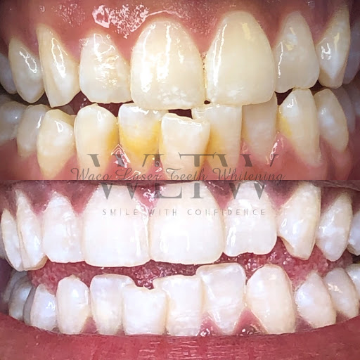 Waco Laser Teeth Whitening